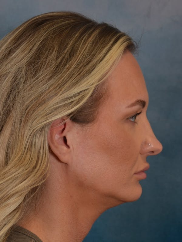 Rhinoplasty Before & After Gallery - Patient 407355 - Image 7