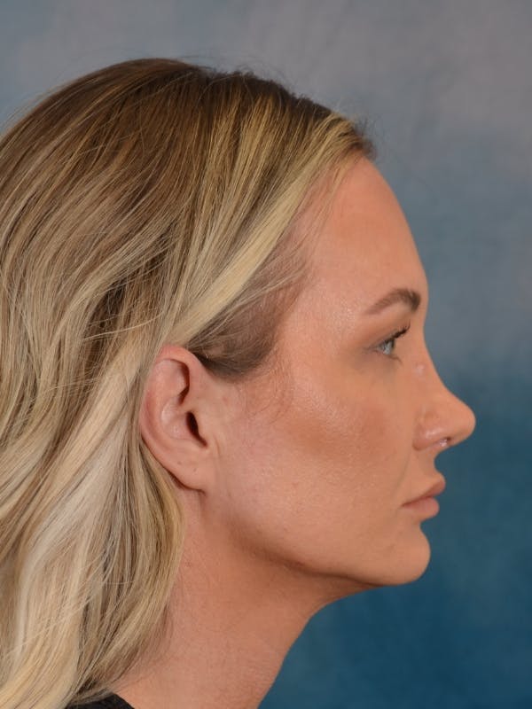 Rhinoplasty Before & After Gallery - Patient 407355 - Image 8