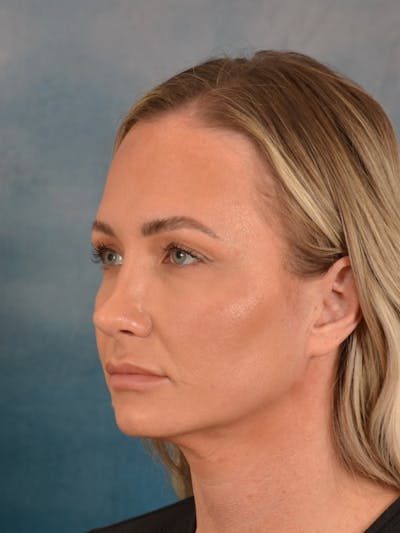 Rhinoplasty Before & After Gallery - Patient 407355 - Image 6