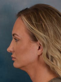 Rhinoplasty Before & After Gallery - Patient 407355 - Image 1