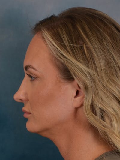 Rhinoplasty Before & After Gallery - Patient 407355 - Image 1