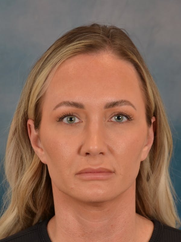 Rhinoplasty Before & After Gallery - Patient 407355 - Image 4