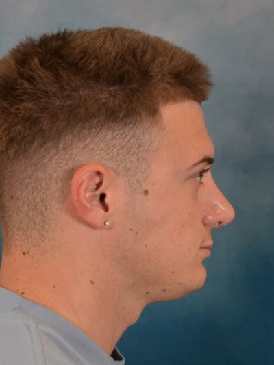 Rhinoplasty Before & After Gallery - Patient 544468 - Image 8