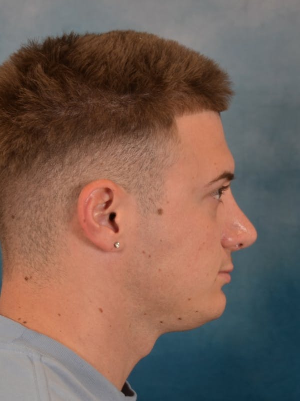 Rhinoplasty Before & After Gallery - Patient 544468 - Image 8