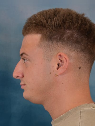 Rhinoplasty Before & After Gallery - Patient 544468 - Image 1