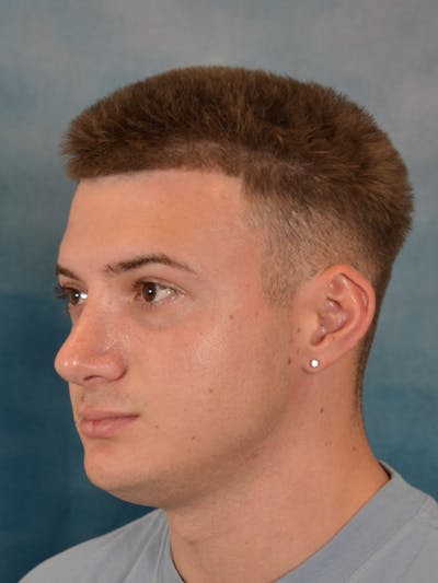 Rhinoplasty Before & After Gallery - Patient 544468 - Image 10