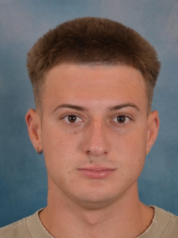 Rhinoplasty Before & After Gallery - Patient 544468 - Image 3