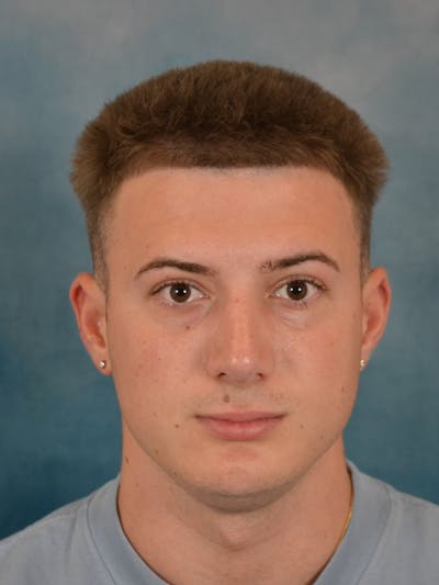 Rhinoplasty Before & After Gallery - Patient 544468 - Image 4
