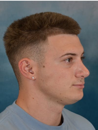 Rhinoplasty Before & After Gallery - Patient 544468 - Image 6