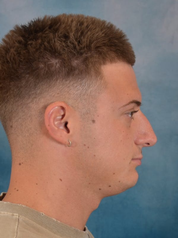 Rhinoplasty Before & After Gallery - Patient 544468 - Image 7