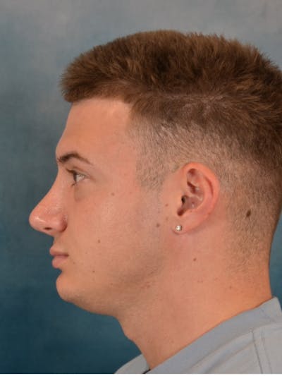 Rhinoplasty Before & After Gallery - Patient 544468 - Image 2