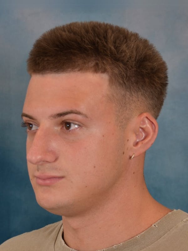 Rhinoplasty Before & After Gallery - Patient 544468 - Image 9