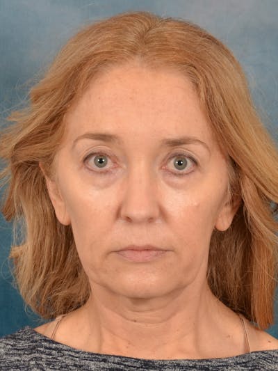 Laser Skin Resurfacing Before & After Gallery - Patient 781146 - Image 1