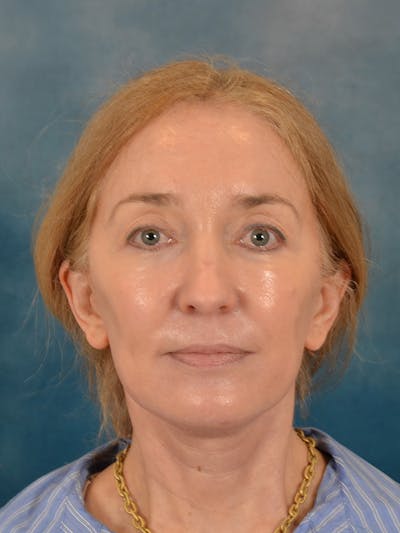 Laser Skin Resurfacing Before & After Gallery - Patient 781146 - Image 2