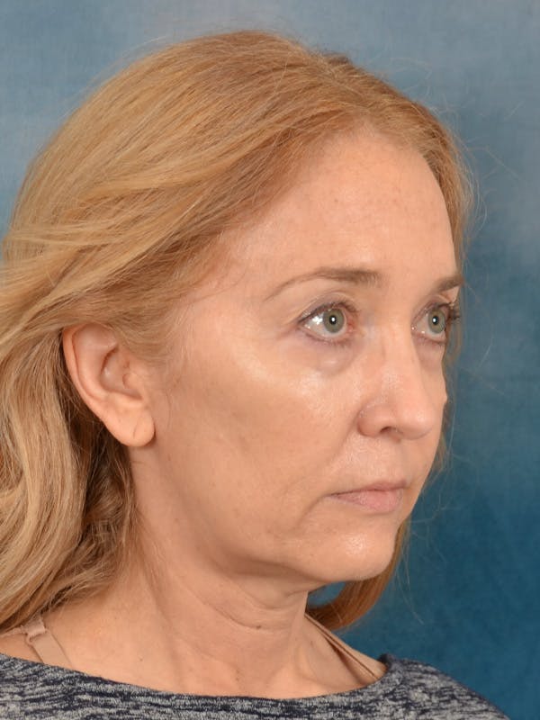Laser Skin Resurfacing Before & After Gallery - Patient 781146 - Image 7
