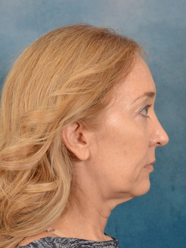 Laser Skin Resurfacing Before & After Gallery - Patient 781146 - Image 9