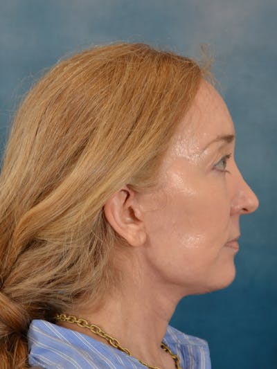 Laser Skin Resurfacing Before & After Gallery - Patient 781146 - Image 10