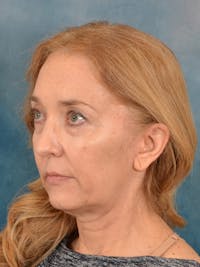 Deep Plane Facelift Before & After Gallery - Patient 142080 - Image 1