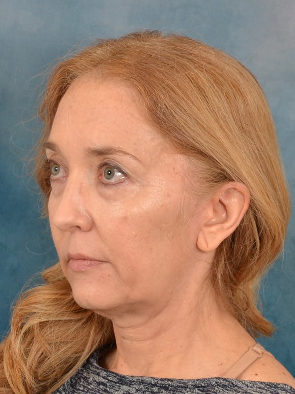 Laser Skin Resurfacing Before & After Gallery - Patient 781146 - Image 3