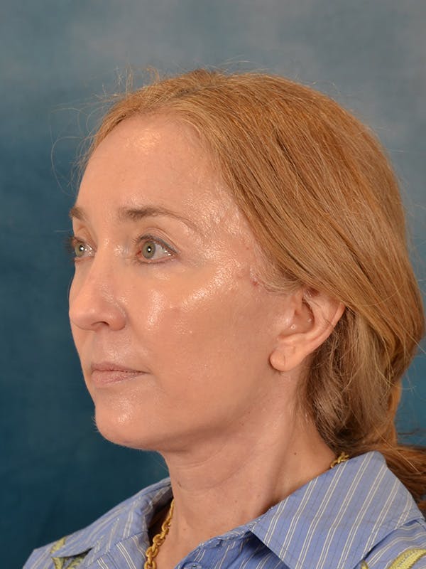 Laser Skin Resurfacing Before & After Gallery - Patient 781146 - Image 4