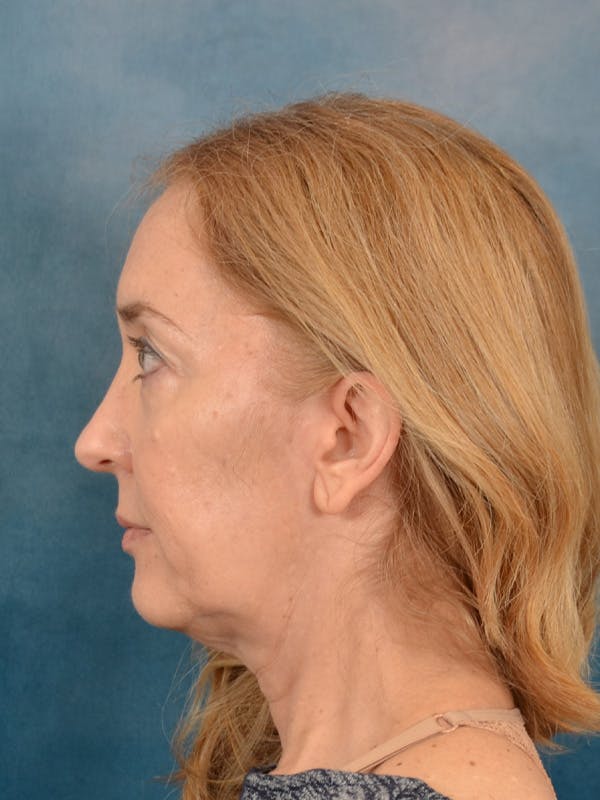 Laser Skin Resurfacing Before & After Gallery - Patient 781146 - Image 5