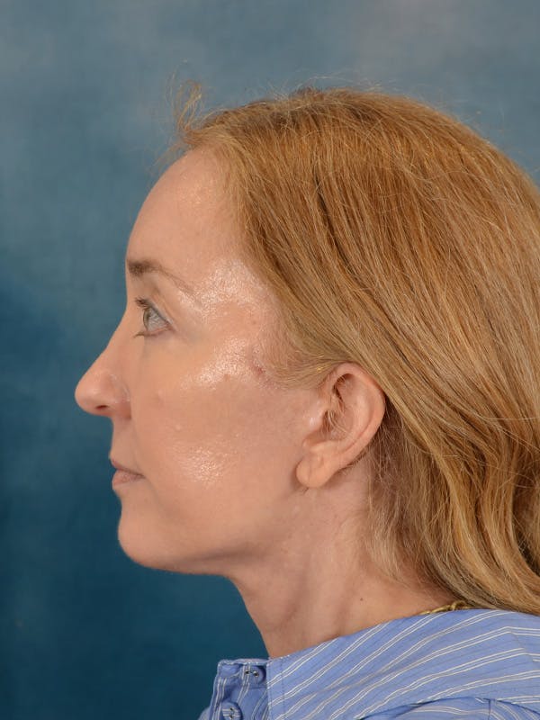 Laser Skin Resurfacing Before & After Gallery - Patient 781146 - Image 6