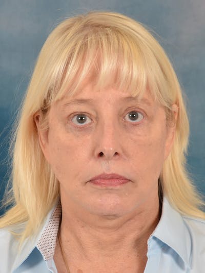 Laser Skin Resurfacing Before & After Gallery - Patient 280684 - Image 2