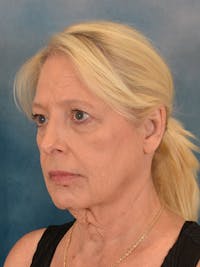 Deep Plane Facelift Before & After Gallery - Patient 182343 - Image 1
