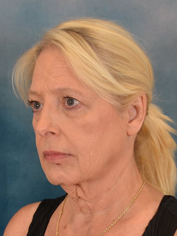 Laser Skin Resurfacing Before & After Gallery - Patient 280684 - Image 3
