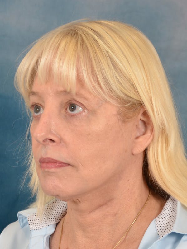 Laser Skin Resurfacing Before & After Gallery - Patient 280684 - Image 4