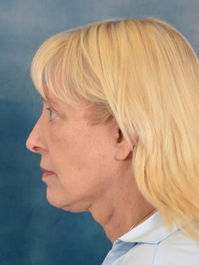 Laser Skin Resurfacing Before & After Gallery - Patient 280684 - Image 6