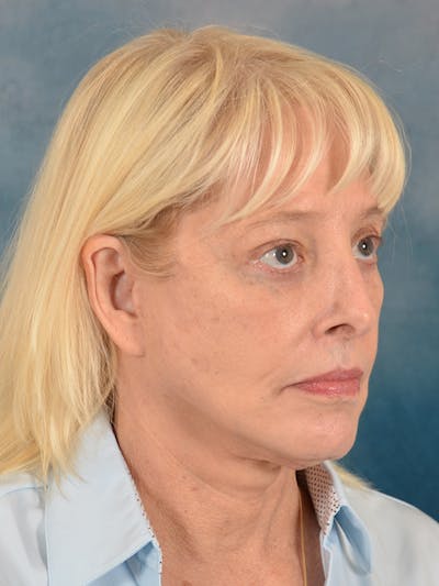 Laser Skin Resurfacing Before & After Gallery - Patient 280684 - Image 8