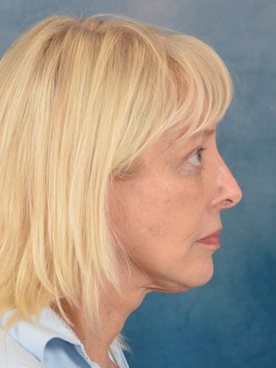 Laser Skin Resurfacing Before & After Gallery - Patient 280684 - Image 10