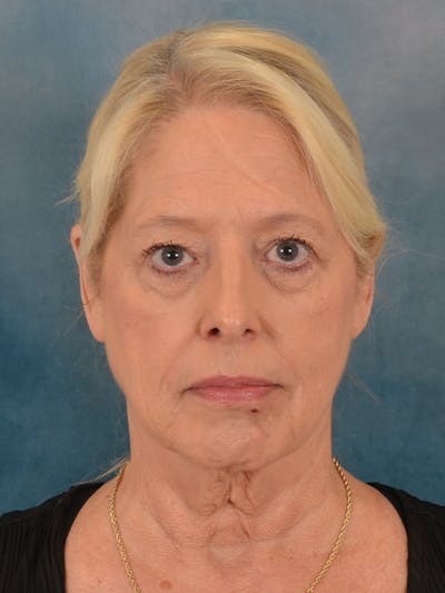 Laser Skin Resurfacing Before & After Gallery - Patient 280684 - Image 1