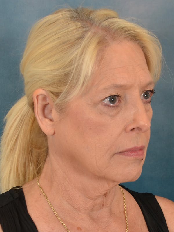 Laser Skin Resurfacing Before & After Gallery - Patient 280684 - Image 7