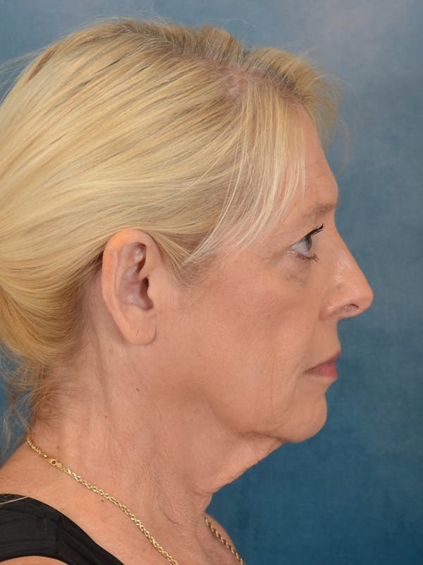 Laser Skin Resurfacing Before & After Gallery - Patient 280684 - Image 9