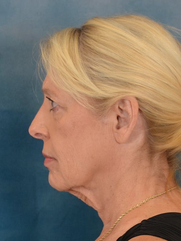 Laser Skin Resurfacing Before & After Gallery - Patient 280684 - Image 5