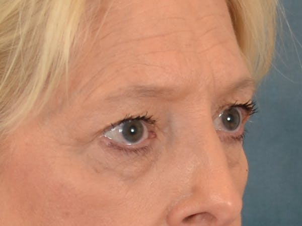 Eyelid Lift Before & After Gallery - Patient 380144 - Image 3