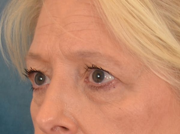 Eyelid Lift Before & After Gallery - Patient 380144 - Image 7