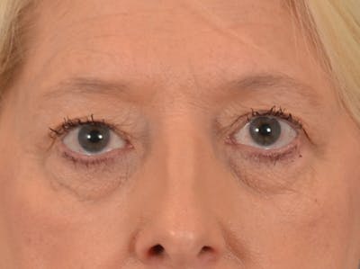 Eyelid Lift Before & After Gallery - Patient 380144 - Image 1