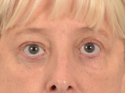 Eyelid Lift Before & After Gallery - Patient 380144 - Image 2