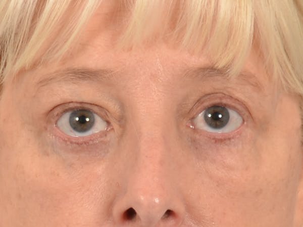 Eyelid Lift Before & After Gallery - Patient 380144 - Image 2