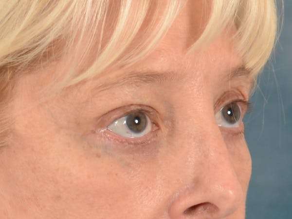 Eyelid Lift Before & After Gallery - Patient 380144 - Image 4