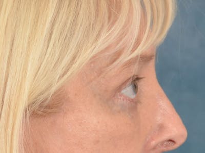 Eyelid Lift Before & After Gallery - Patient 380144 - Image 6