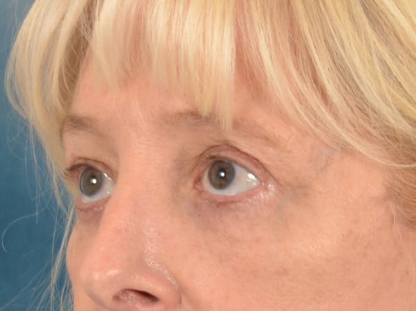 Eyelid Lift Before & After Gallery - Patient 380144 - Image 8