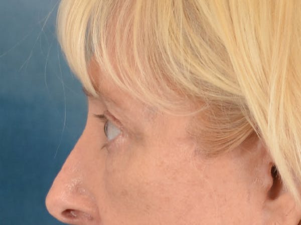 Eyelid Lift Before & After Gallery - Patient 380144 - Image 10