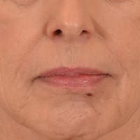 Lip Lift Before & After Gallery - Patient 236622 - Image 1