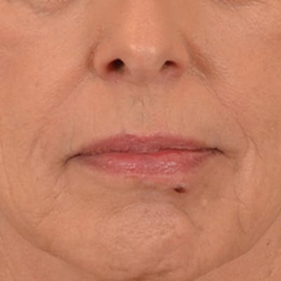 Lip Lift Before & After Gallery - Patient 236622 - Image 1