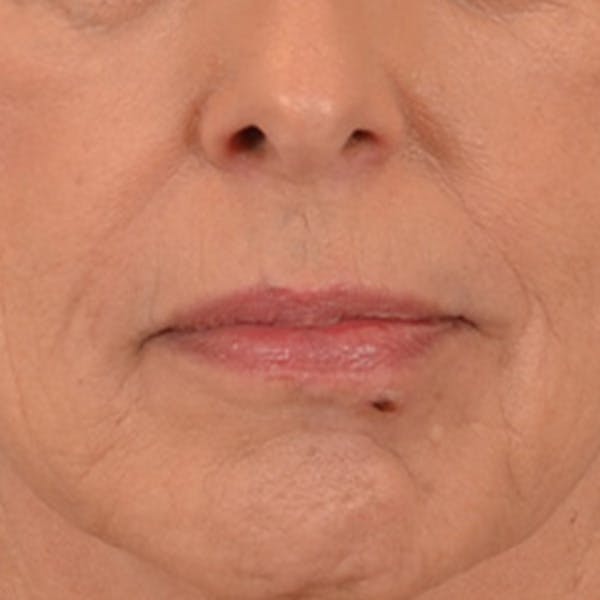 Lip Lift Before & After Gallery - Patient 236622 - Image 1