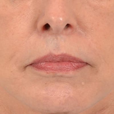 Lip Lift Before & After Gallery - Patient 236622 - Image 2